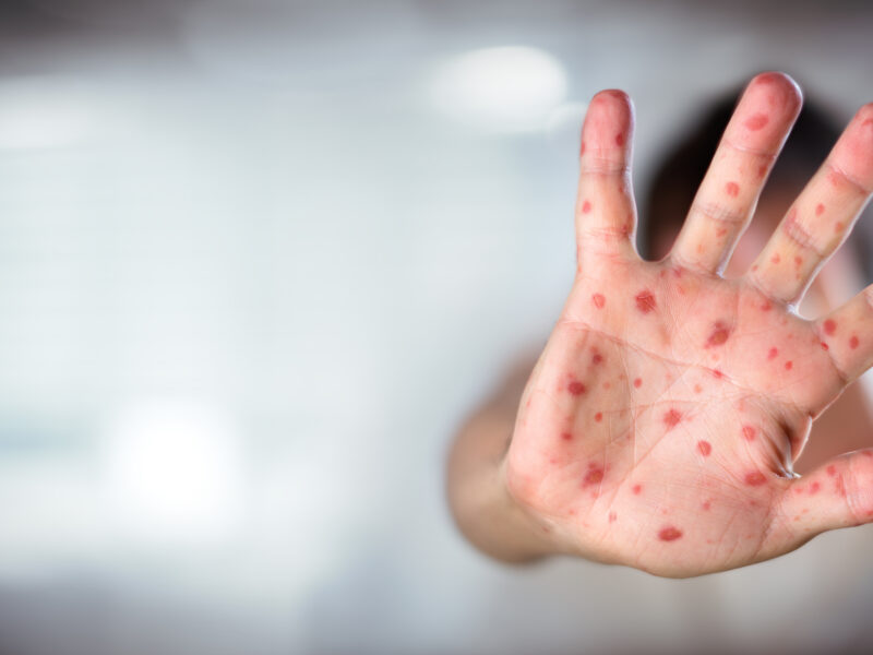 A child's hand that has been affected by measles